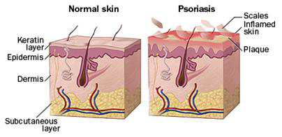 normal skin vs.psoriasis