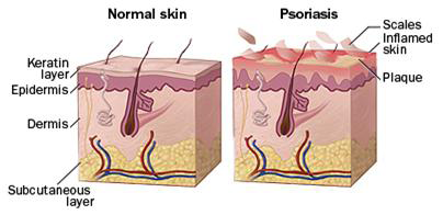 Zdrava kuze versus kuze postizena psoriazou