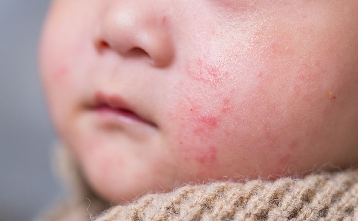 Az ötödik betegség gyermekeknél – útmutató szülőknek