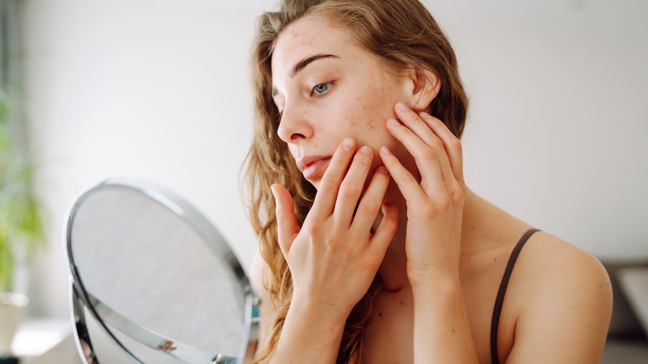 Vă deranjează erupția cutanată pe față? Iată motivele ascunse