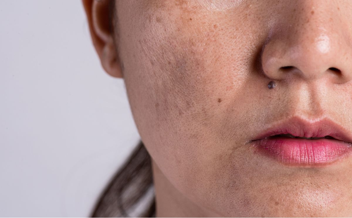 Petele pigmentare: cum să le prevenim și cum să eliminăm pigmentarea nedorită