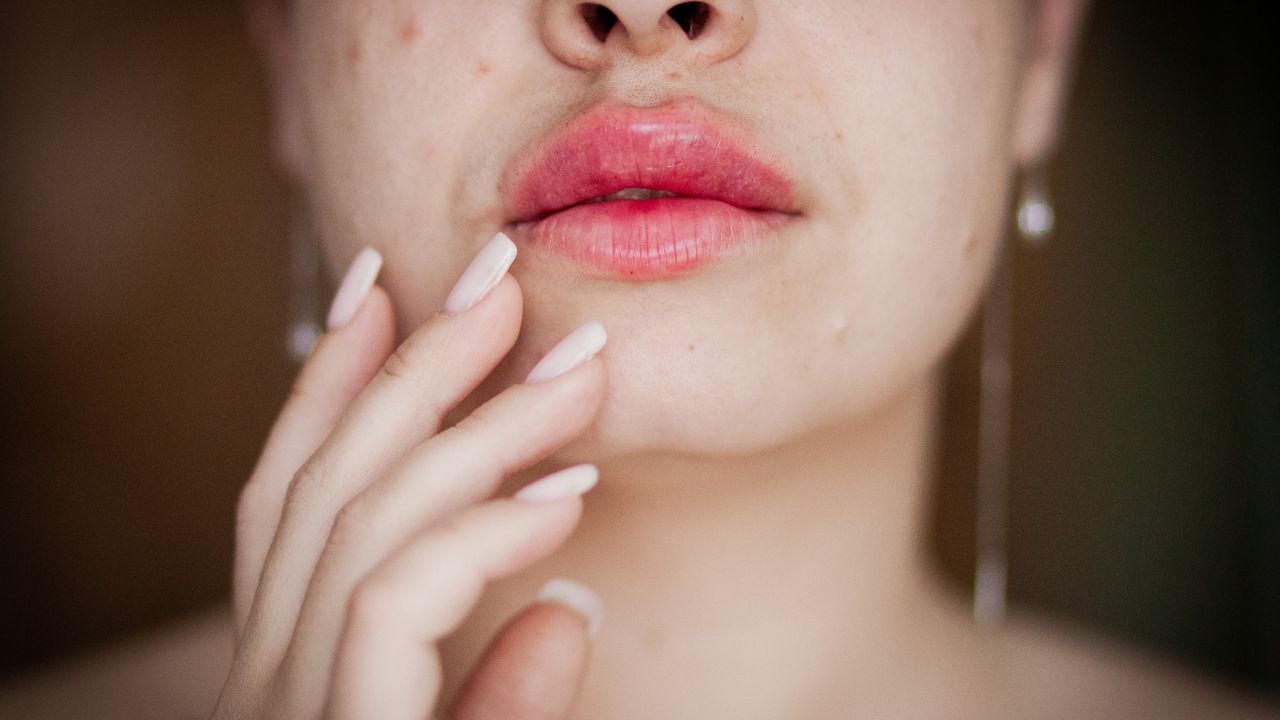 Herpes: Keď sa vírus hlási o slovo. Ako ho zvládnuť prírodne a bez paniky?