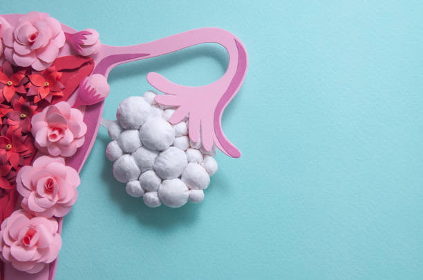 Syndrom polycystických ovarií (PCOS): Jak zmírnit příznaky?