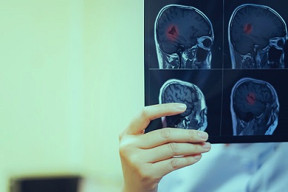 CBD jako pomocník při mozkové příhodě