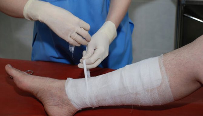 Bércové vředy - co to je a jak je léčit?