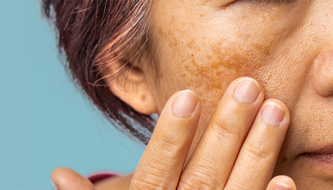 Pigmentové skvrny: Jak vybrat účinný produkt