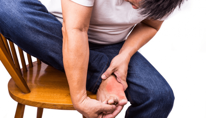 Řešení pro dnavý záchvat: Prevence a léčba