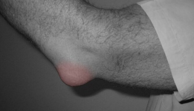 Bursitida - zánět tíhového váčku