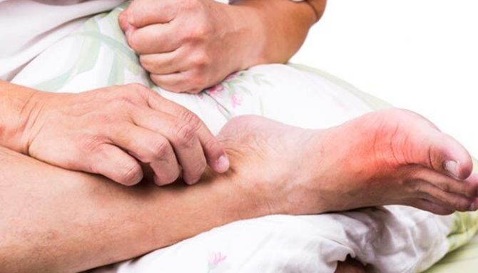 Jak snížit riziko dnavých záchvatů: Praktické tipy a léčba