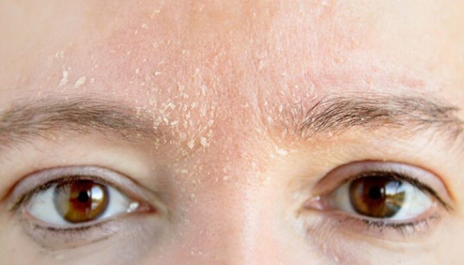 Zimní Kožní Problémy: Péče o Pokožku v Zimě