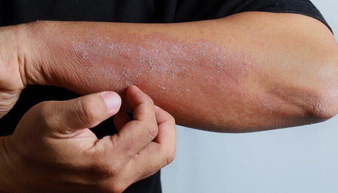 Je lupénka nakažlivá?