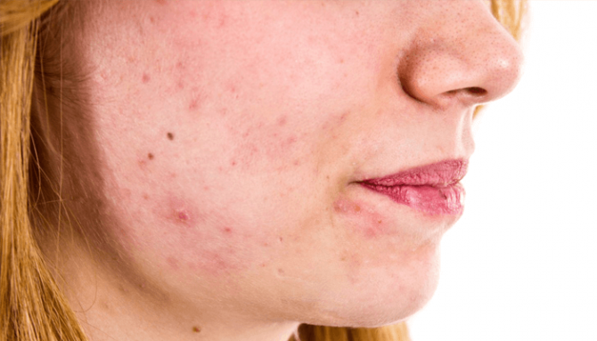 Nejčastější druhy vyrážek