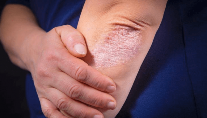 Příznaky a druhy lupénky