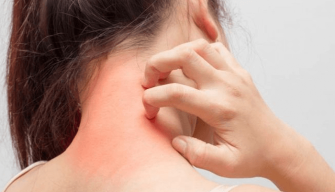 Tyto potraviny Vás zbaví ekzému