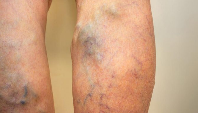 Dejte si pozor na zánět povrchových žil!