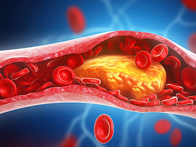 Přírodou na vysoký cholesterol a krevní tlak