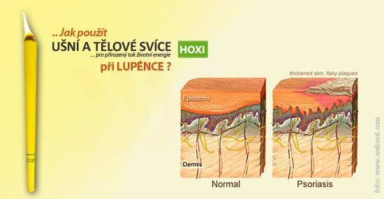 Aplikace tělové svíce HOXI při Lupénce