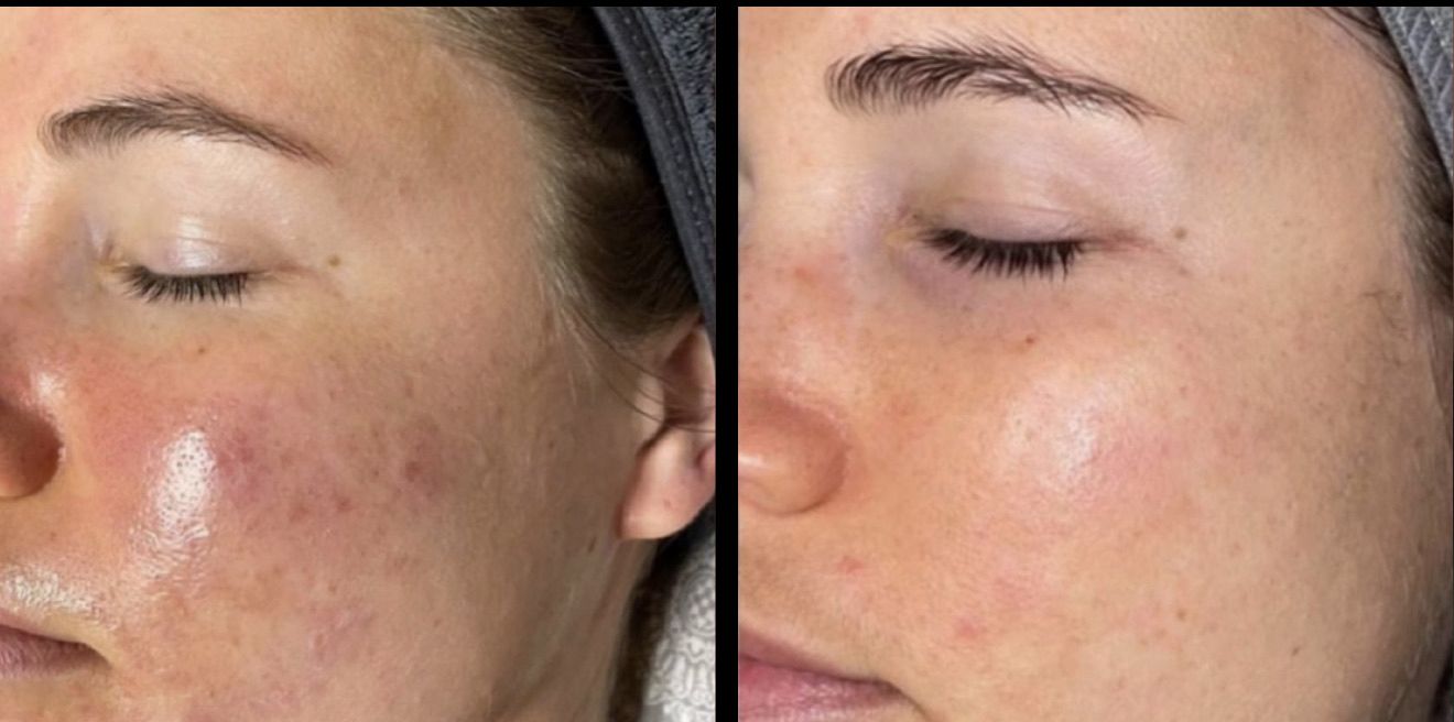 Před a po aplikaci Altum Peptide – tváře