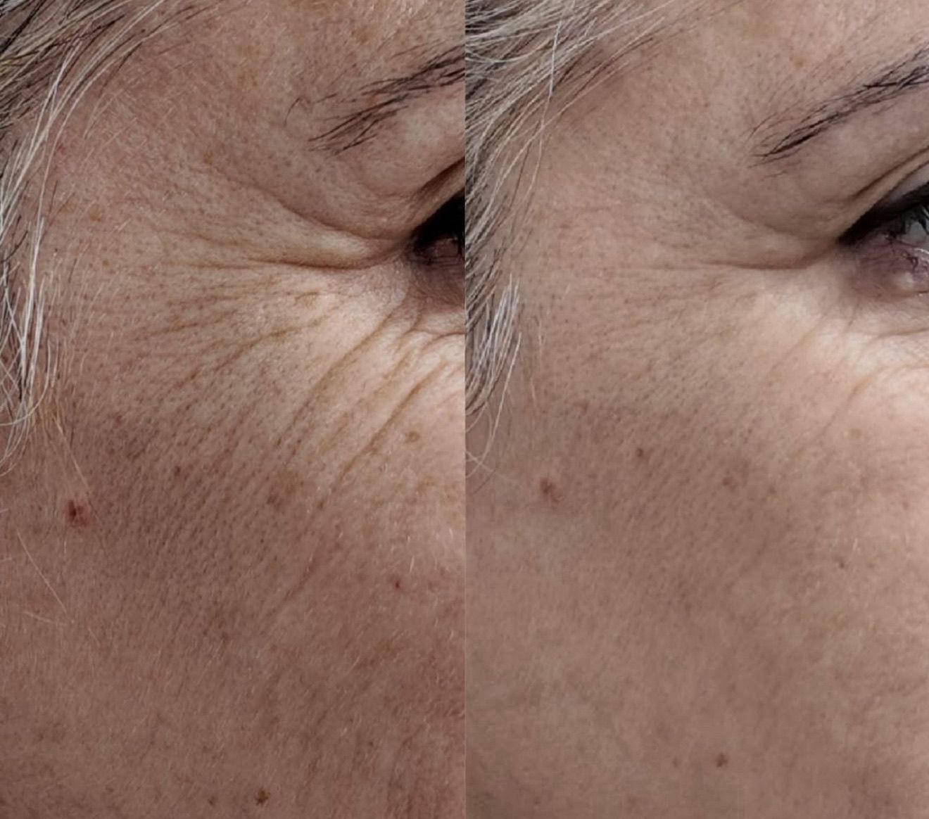 Před a po aplikaci Altum Peptide – okolí očí