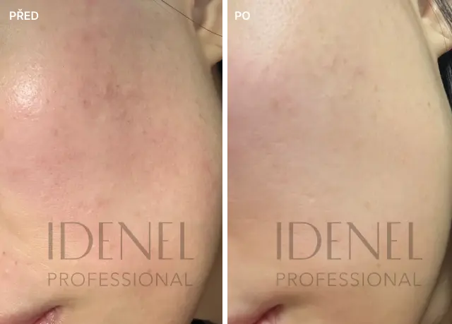 Reference před a po – IDENEL Professional