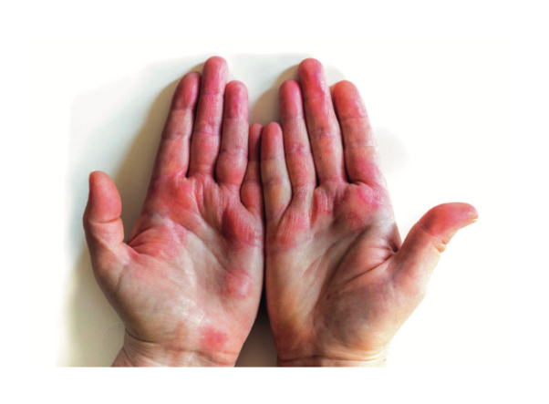 Alergické reakce a jak s tím souvisí rukavice s pudrem nebo bez pudru?