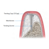 Tenting Cap (T/Cap)
