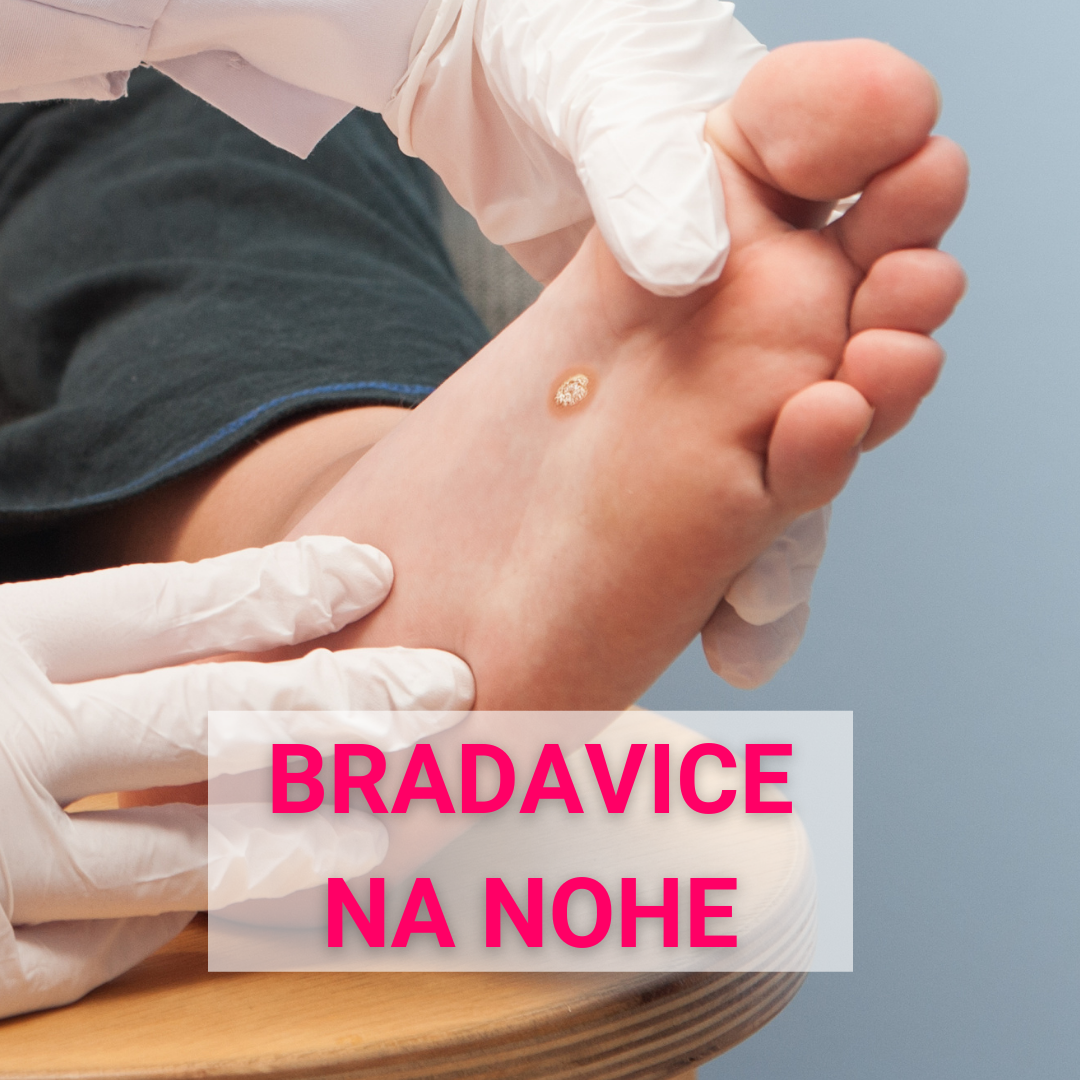 Bradavice na nohe