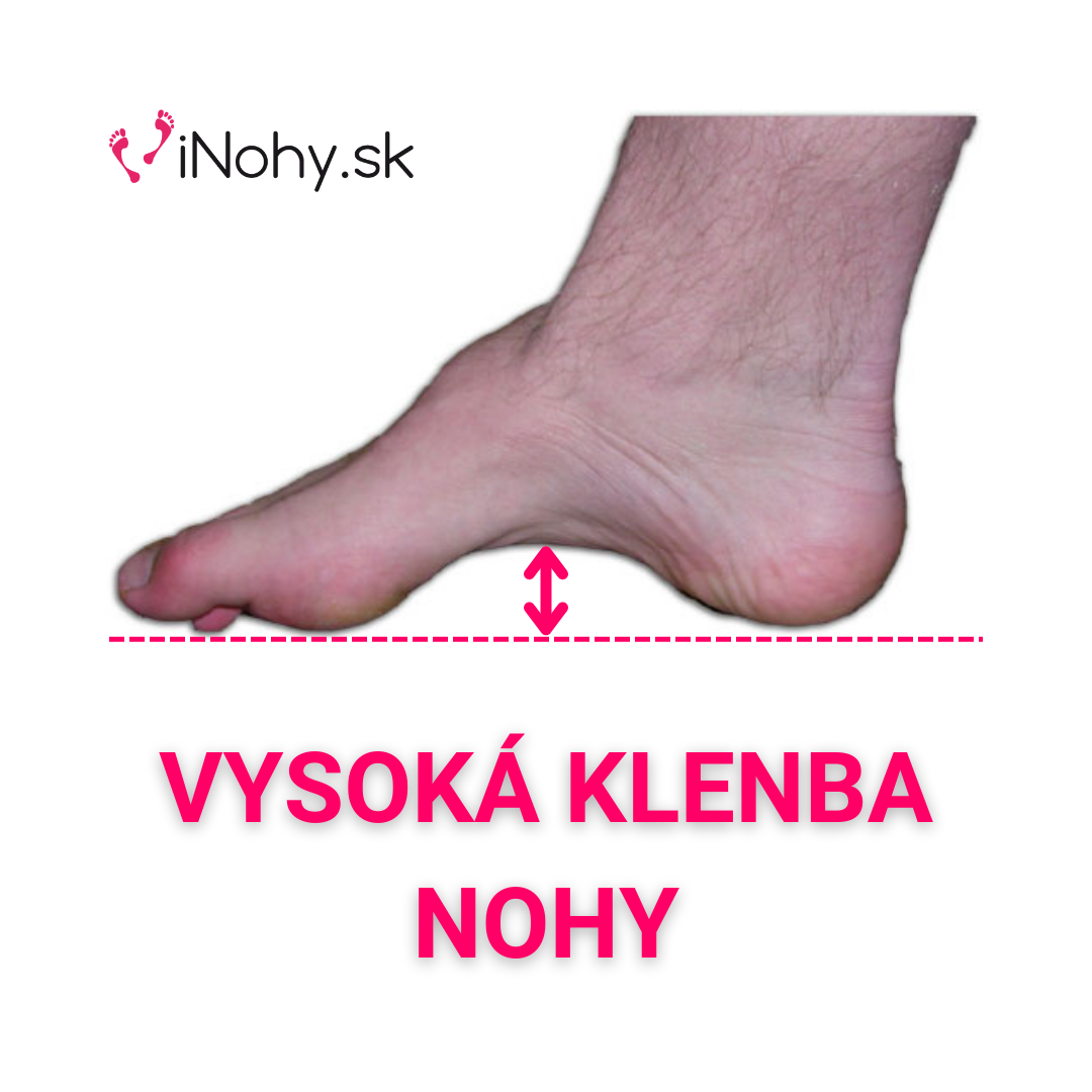 Vysoká klenba nohy