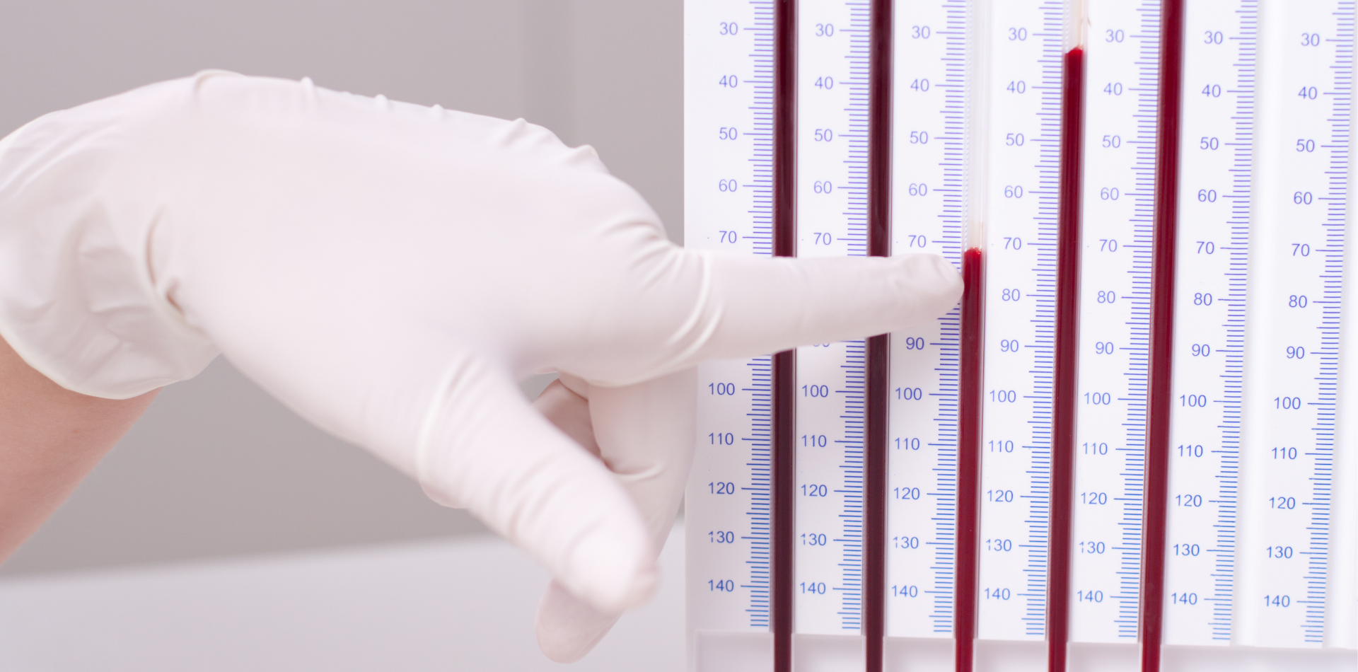 Čo o pacientovi prezradí sedimentácia erytrocytov