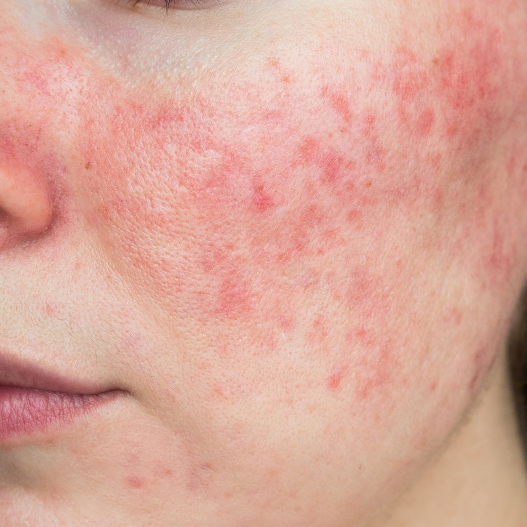 Rosacea - proč vzniká a co ji ovlivňuje?