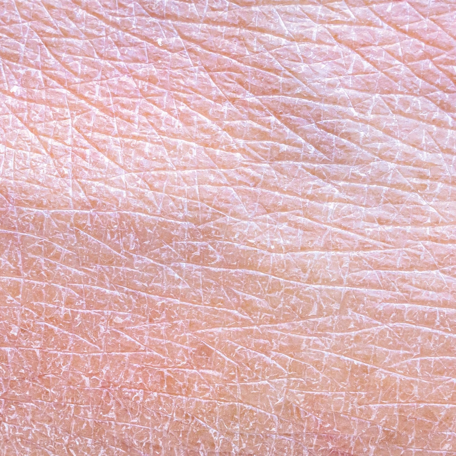 (De)hydratace pleti v zimě