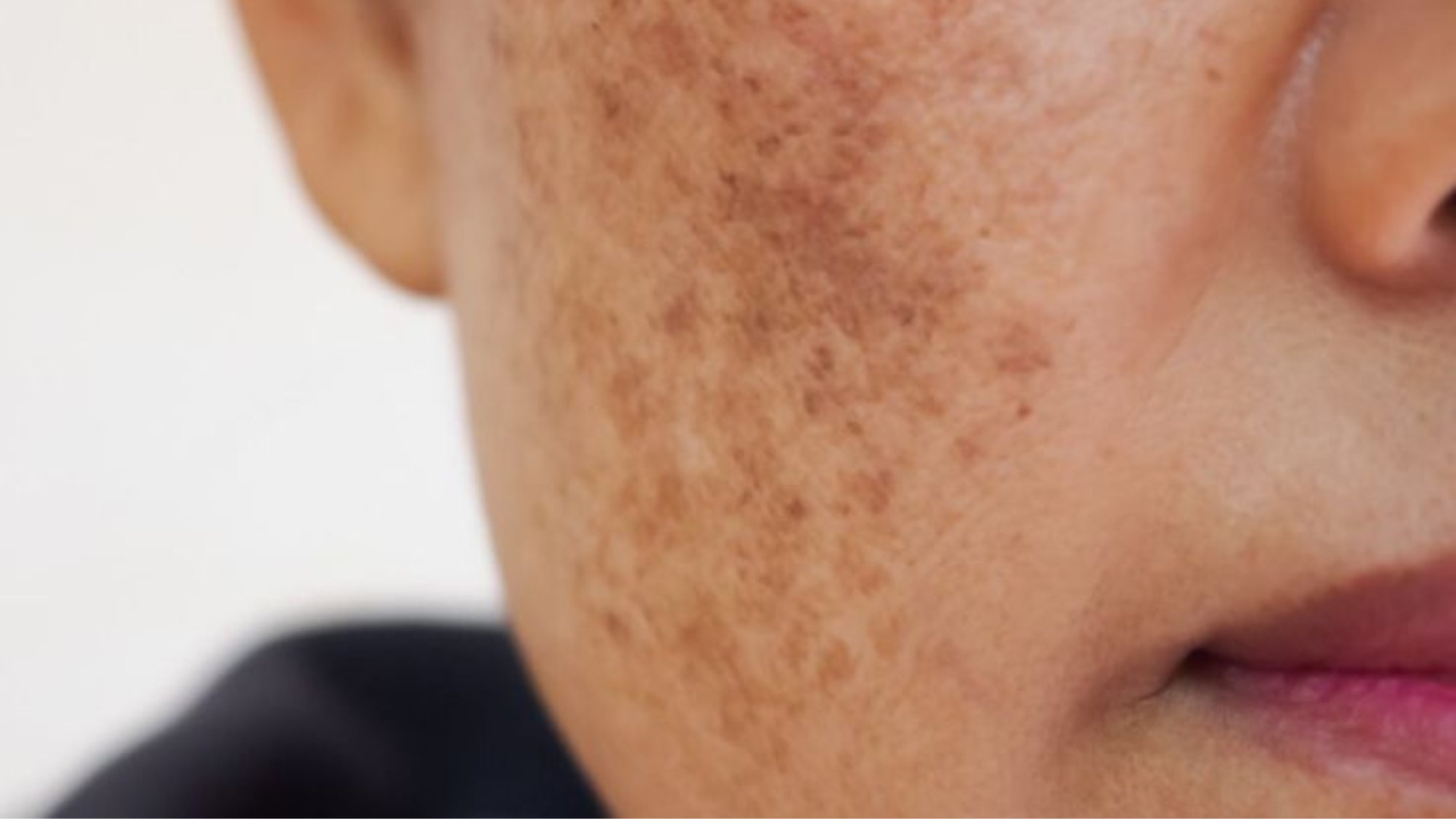 Pigmentové skvrny a jak se jich zbavit