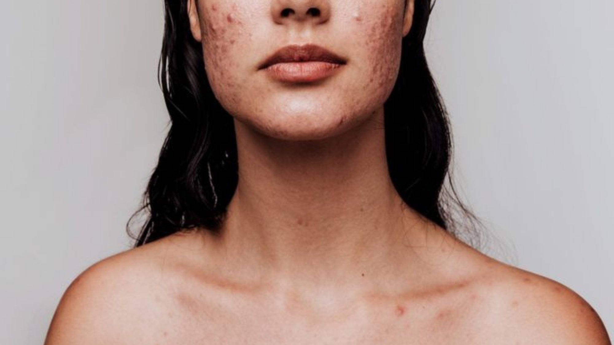 Jak na akné podle korejské kosmetiky?