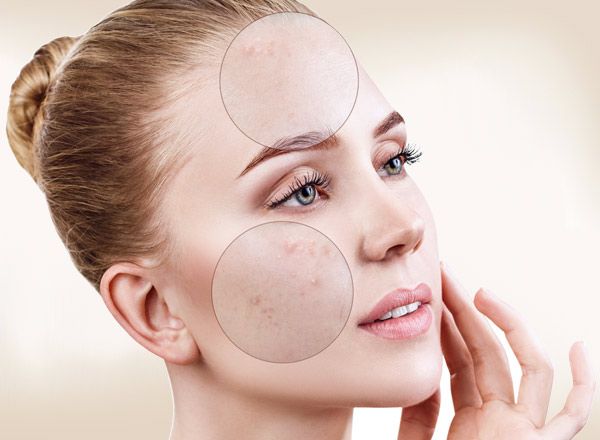 Pigmentové skvrny – lze se jich zbavit? První pomoc a SPF