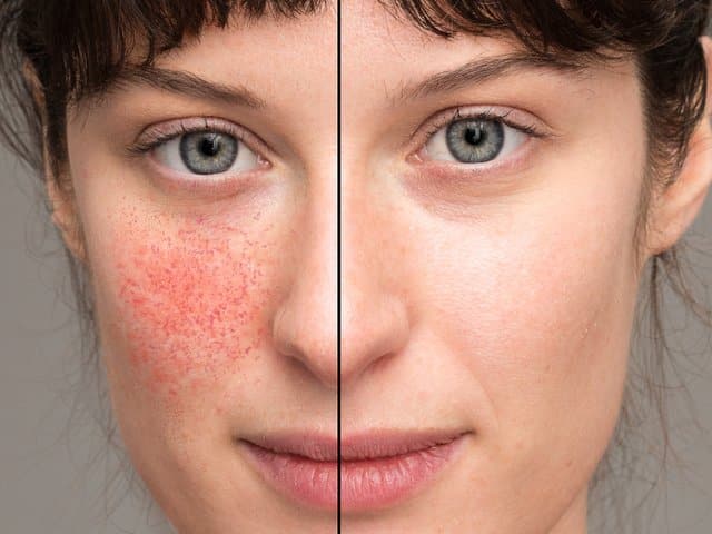 Rosacea – amikor a bőr napfény nélkül is „ég”