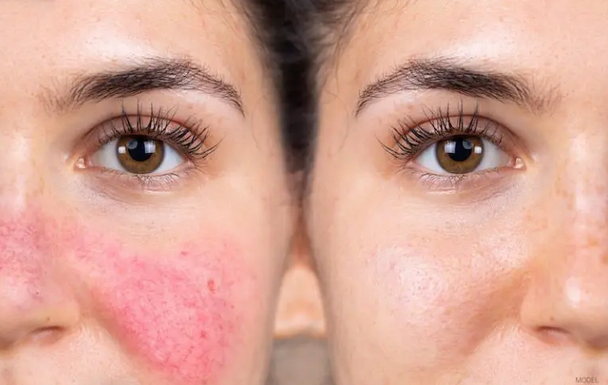 Ako odstrániť začervenanie tváre: podráždenie, zápal, chronické začervenanie