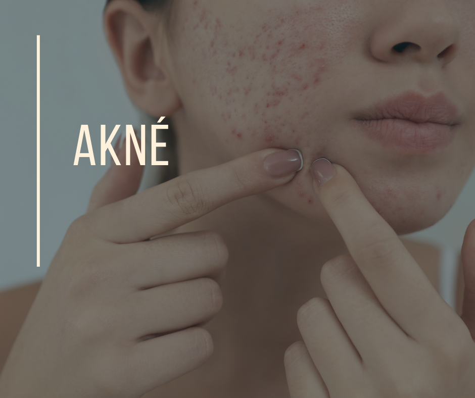 AKNÉ