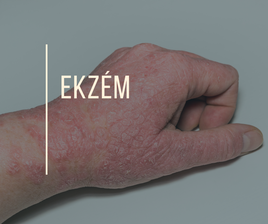 EKZÉM