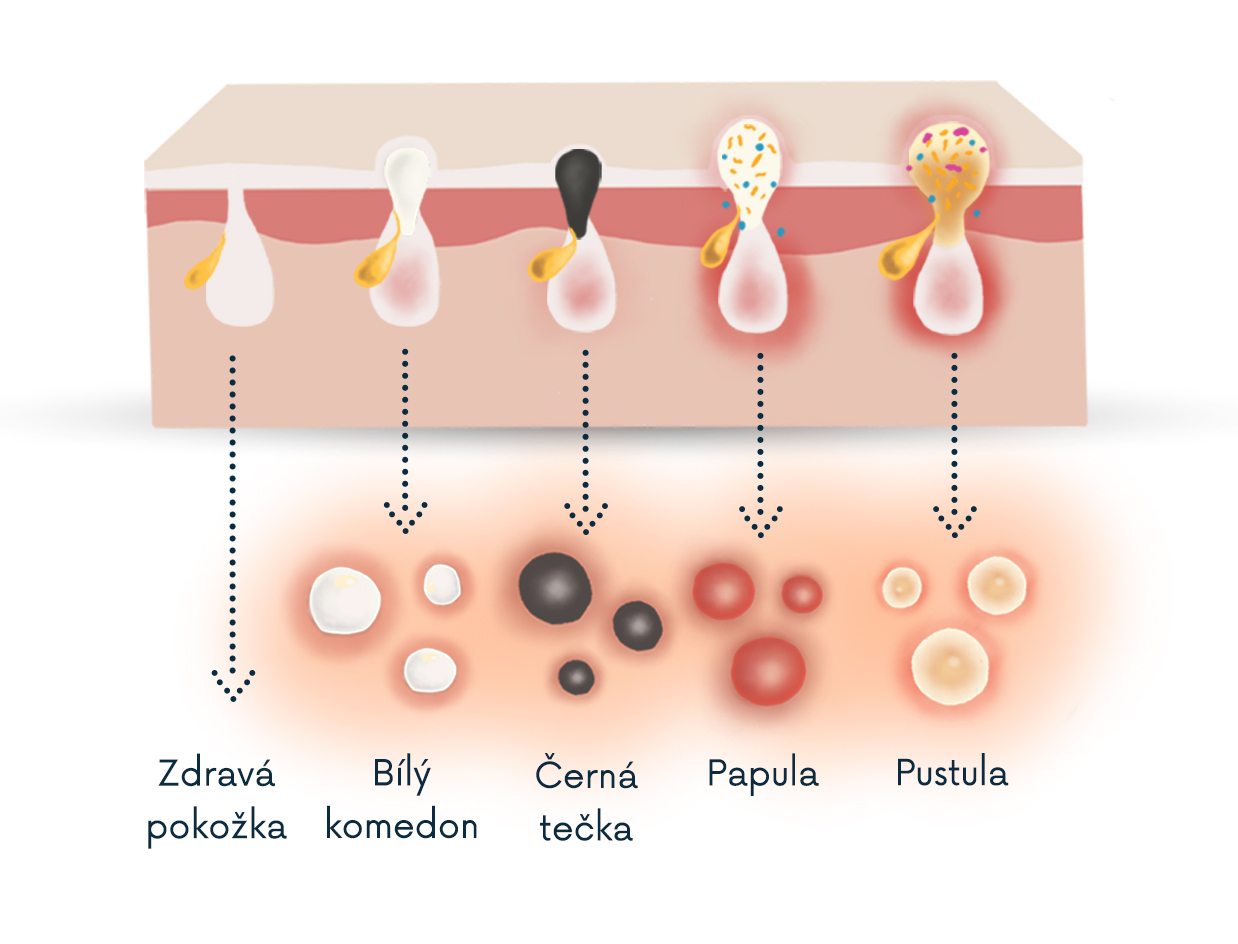 typy-akne-2
