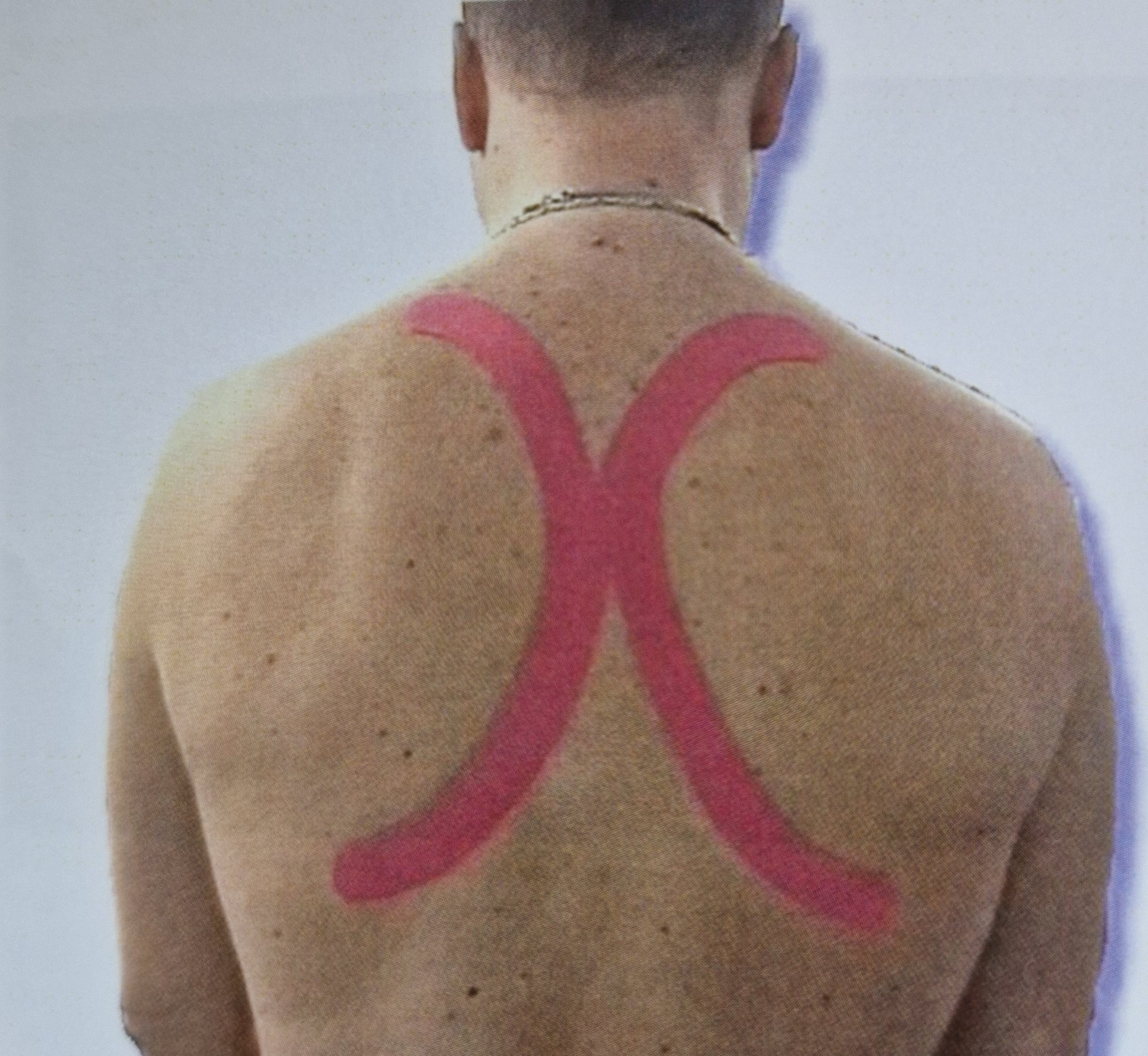 Tejpem proti alergii