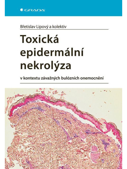 Toxická epidermální nekrolýza v kontextu závažných bulózních onemocnění