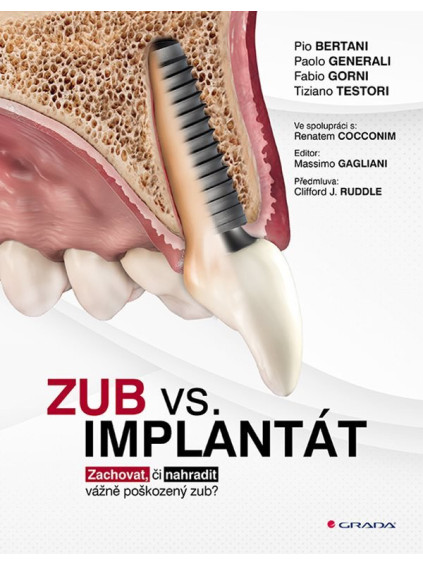 Zub vs. implantát - Zachovat, či nahradit vážně poškozený zub?