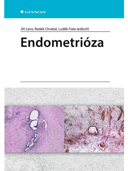 Endometrióza