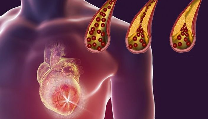 Cholesterol a krevní tlak – jak je snížit?