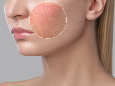 5 nejlepších ingrediencí pro péči o citlivou pleť v roce 2024