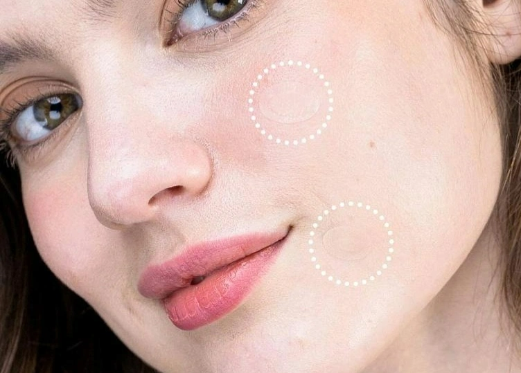 Problematická pleť