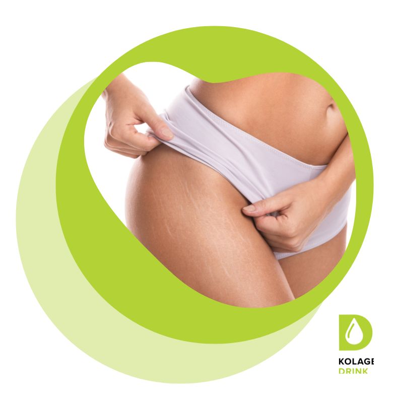 Kolagen a strie: Jak může pomoci a co o tom říká věda