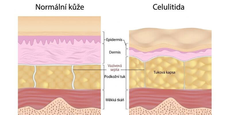 Schéma normální kůže a celulitidy s vazivovými septy a podkožní tukovou tkání