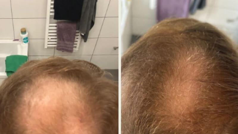 Gabriel před a po používání séra Bio-Pilixin v kombinaci s dermarollerem