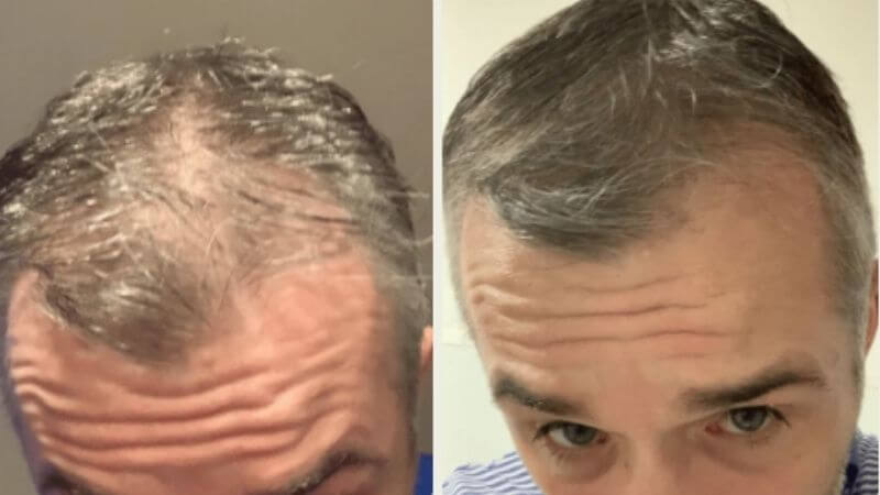 Paul před a po roce používání produktů Scandinavian Biolabs